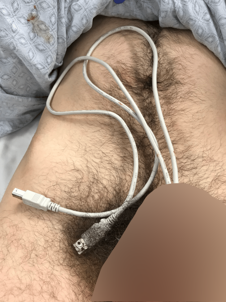 Fel akarta magát izgatni a srác, beszorult a húgycsövébe az USB kábel